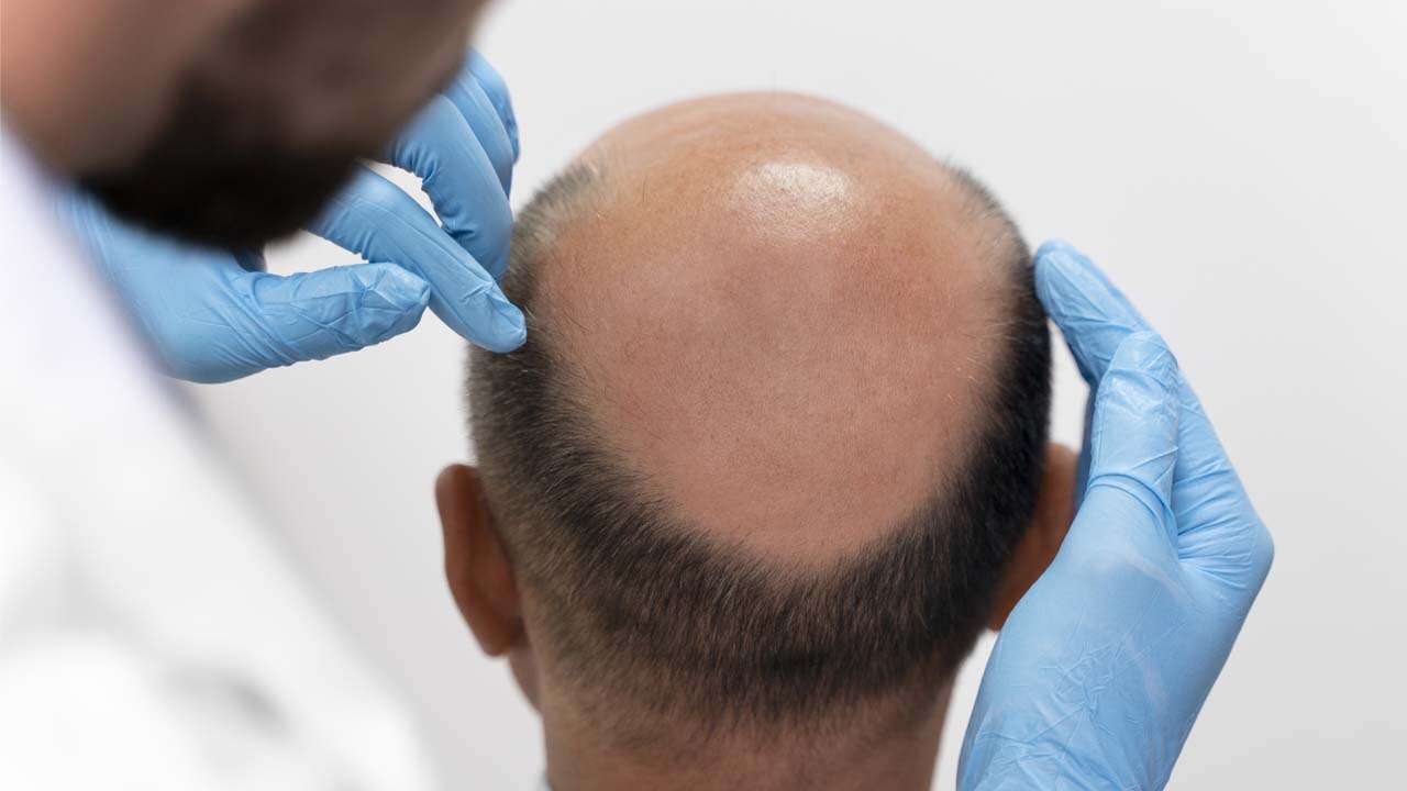 Kelliğe Karşı Geliştirilen Yeni Hap Son Aşamaya Geldi