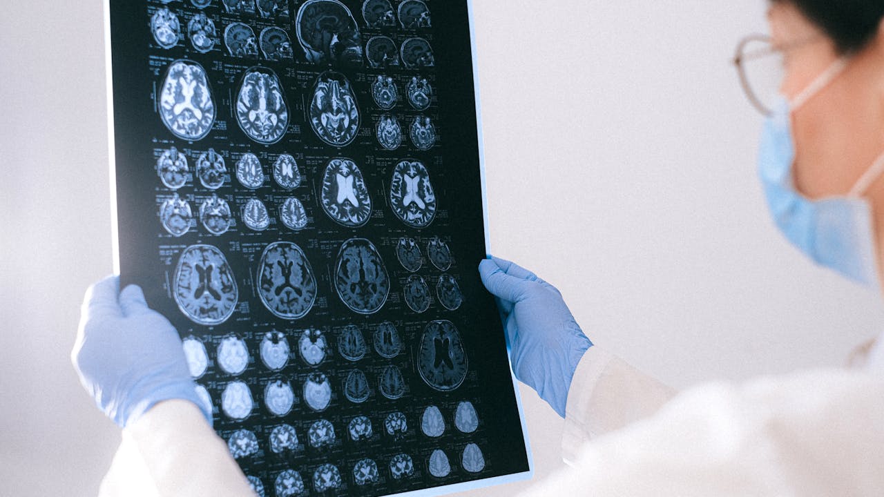 Alzheimer’ın gizli işareti! Eğer vücudunuzda bunlar varsa hemen doktora gidin