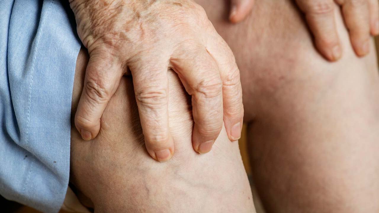 Vücuttaki ödem ve şişkinliğe son uzmanlardan 4 etkili çözüm